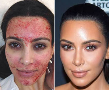 Shamelessly using a photo of a Kardashian to illustrate what a vampire facial with platelet-rich plasma looks like