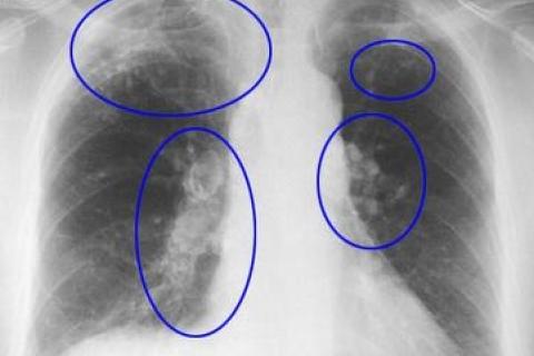 Picture of Silicosis of the Lung